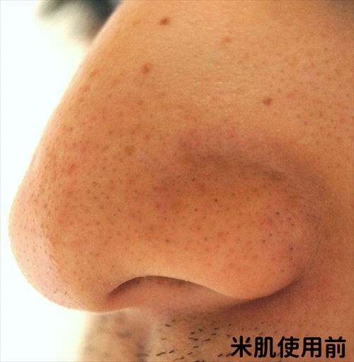 米肌使用前　右小鼻